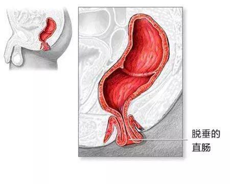 肛门口脱出的"小肉球"到底是什么?