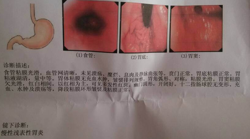 返流性胃炎 腾讯网
