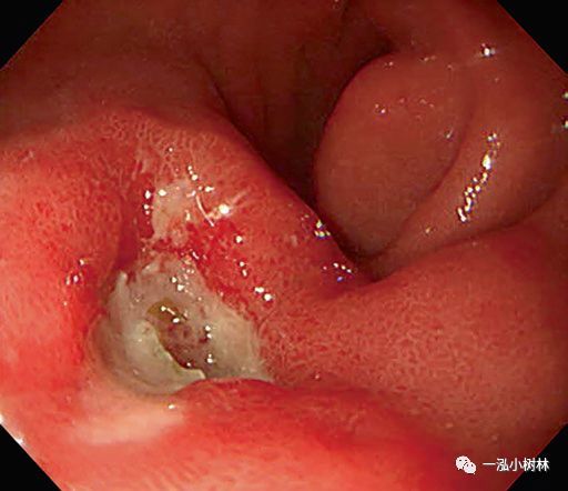 十二指腸球部潰瘍 a1期十二指腸潰瘍是消化科常見疾病.