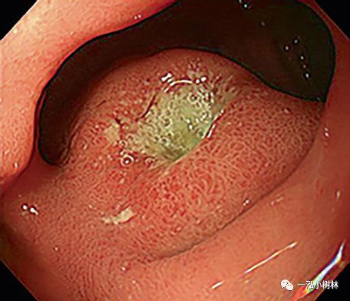 十二指肠球部溃疡 a1期十二指肠球部溃疡 a1期