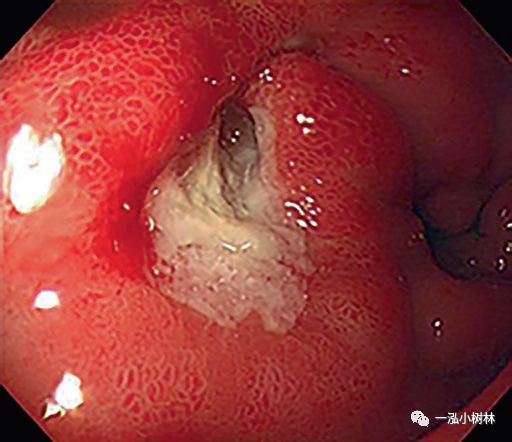 十二指腸潰瘍圖譜|內鏡集錦