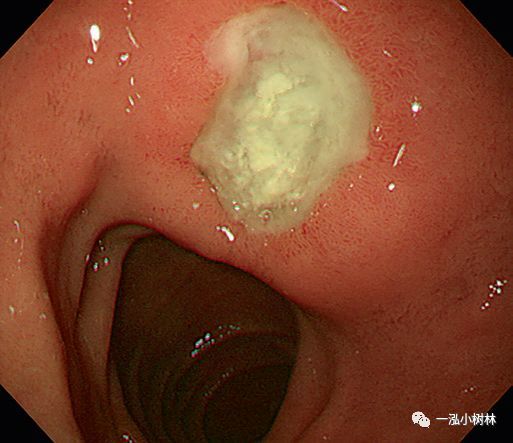 十二指腸潰瘍圖譜|內鏡集錦