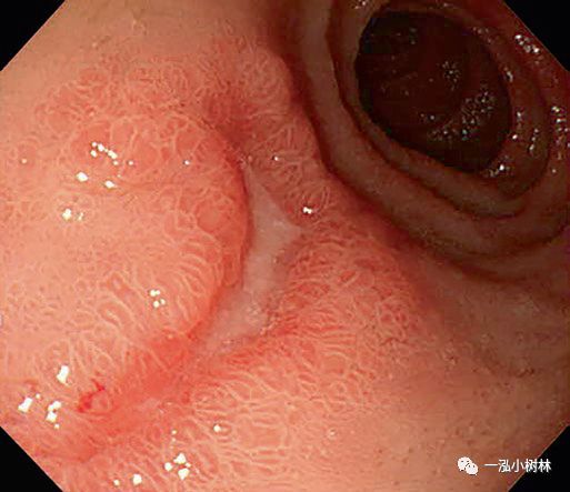 十二指腸球部潰瘍 h1期十二指腸球部潰瘍 h1期十二指腸球部潰瘍h1期