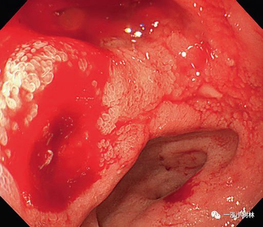 十二指肠球部溃疡出血 ib十二指肠球部溃疡出血 ib十二指肠球部溃疡