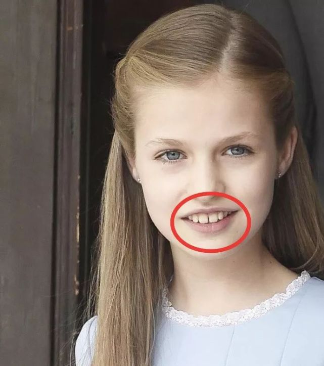 姐姐从小的门牙缝隙就大,长大后门牙变大了,牙缝倒是没那么明显,但