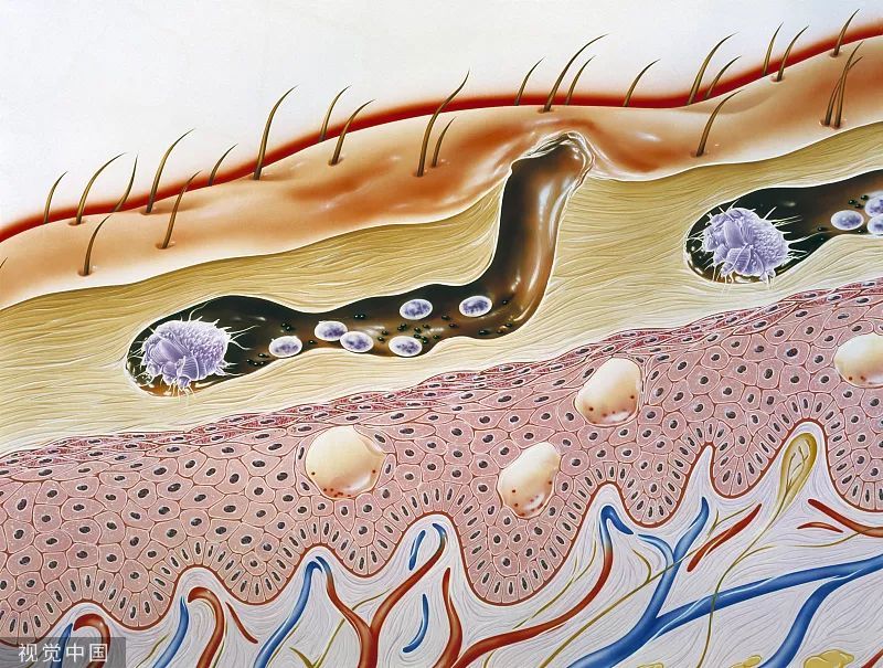 眼睛奇痒无比竟是"螨虫"作祟!人人都可能中招?有这些习惯要注意!