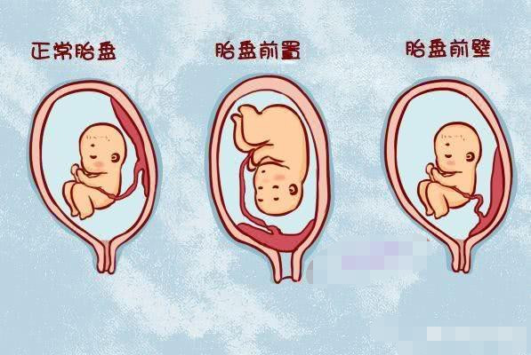 怀孕胎盘位于前壁经常散步可以吗会不会很危险散步时间大概半个小时