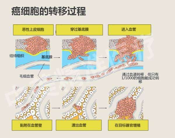 癌细胞扩散了就只能等死 医生说有两种情况 有一种是可以治愈的 腾讯新闻