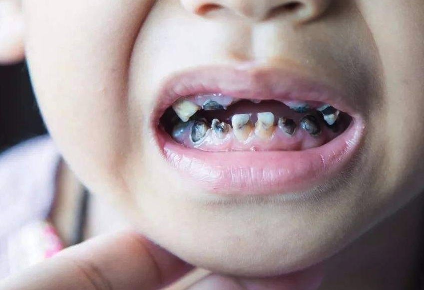 除了吃糖会导致孩子蛀牙外这3点原因家长也要注意