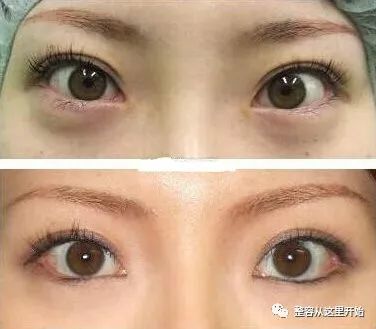 什么样的眼型不适合开眼角