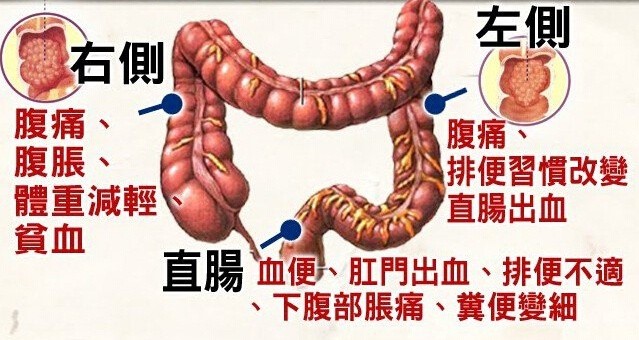 大便不成形一定是肠癌吗 别慌 医生告诉你怎么办 腾讯新闻