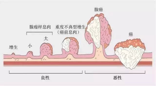 内镜活检发现高级别上皮内瘤变 该怎么办 腾讯新闻