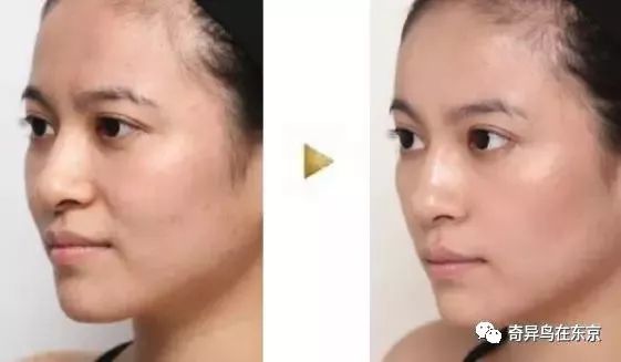 鼻唇沟纹怎么去除,去除鼻唇沟皱纹