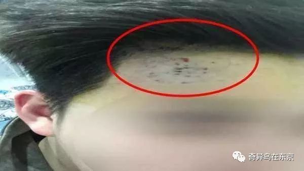 鼻唇沟纹怎么去除,去除鼻唇沟皱纹