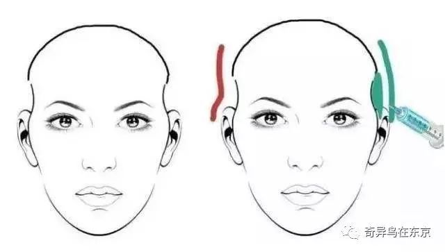 鼻唇沟纹怎么去除,去除鼻唇沟皱纹