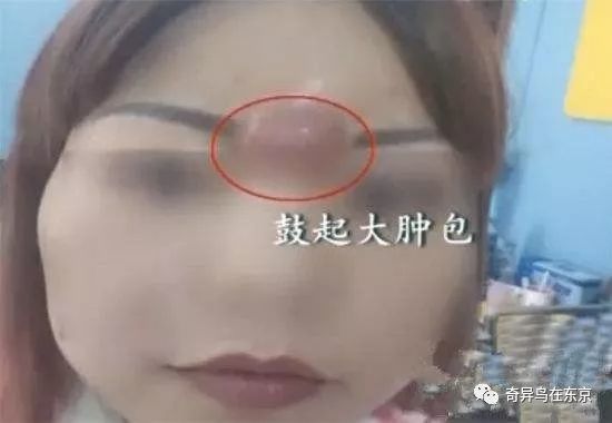 鼻唇沟纹怎么去除,去除鼻唇沟皱纹