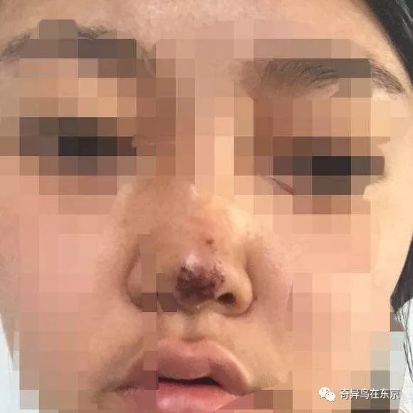 鼻唇沟纹怎么去除,去除鼻唇沟皱纹