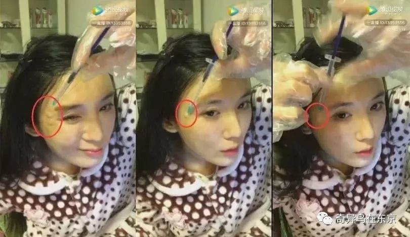 鼻唇沟纹怎么去除,去除鼻唇沟皱纹