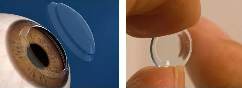 叫"角膜塑形镜" 角膜塑形镜是一种特殊几何形态设计的硬性角膜接触镜