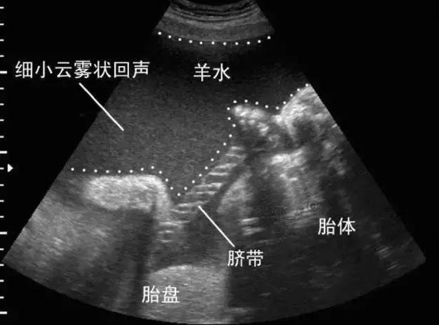 羊水名称的由来 为什么不叫胎水 人水呢 答案在这里 腾讯新闻
