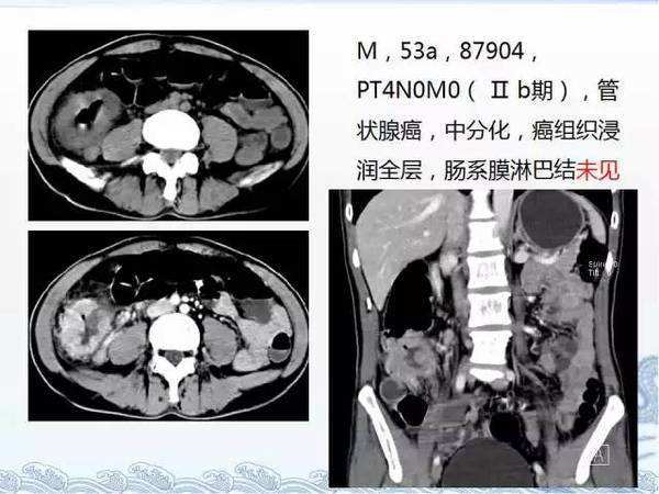 女子诊断结肠癌 不想拖累家庭选择轻生 结肠癌到底有多可怕 腾讯新闻