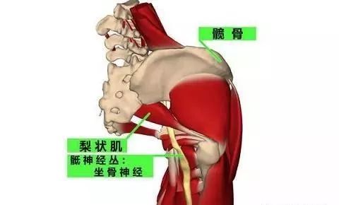 梨狀肌綜合徵