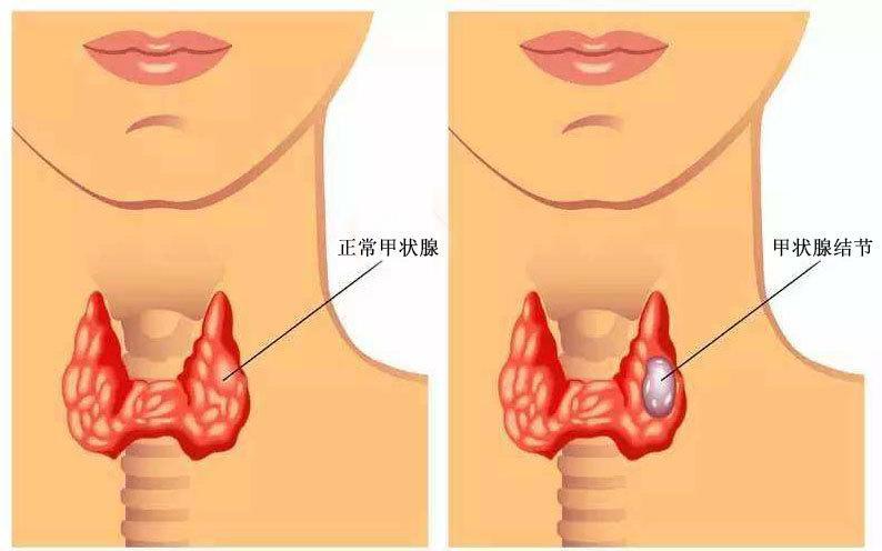 甲状腺结节究竟有多严重?请认真读完本文 让你