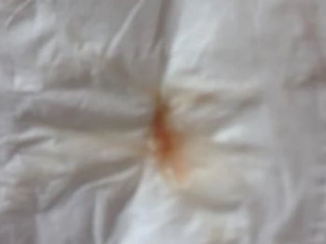 由于刺激宫颈腺体分泌功能亢进,产生粘液样白带,随着癌症的发展,癌