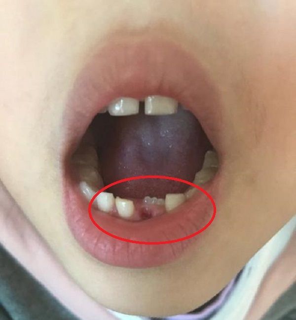 父母不注意这4点,小心孩子牙齿长歪,第一个很多家长都中招了