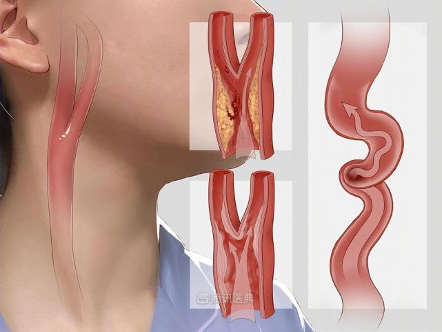 颈动脉结节位置图片