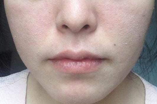 换季皮肤干燥起白屑护肤掌握这2点让皮肤保持光滑有弹性