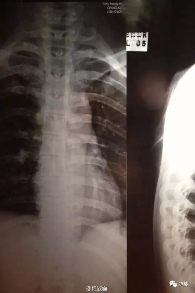 钟欣潼|离奇受伤的阿娇，又有新故事了