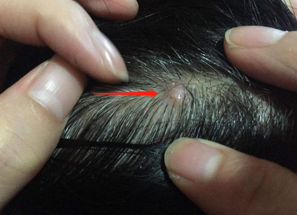 头上感染了真菌