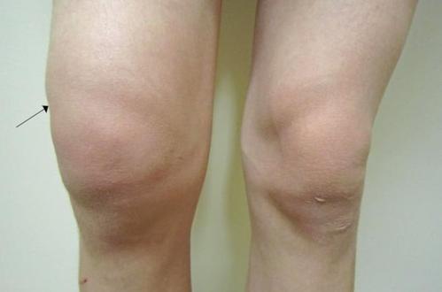 膝盖出现这4个症状,是滑膜炎早期的信号