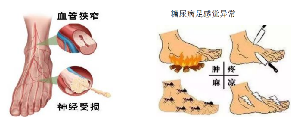 糖尿病足有哪些表现 需要做哪些检查 腾讯新闻