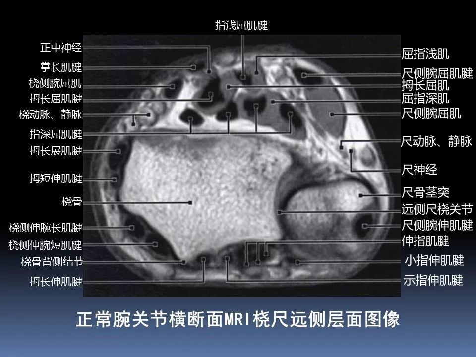 【骨科学术】腕关节的mri解读,最全了!