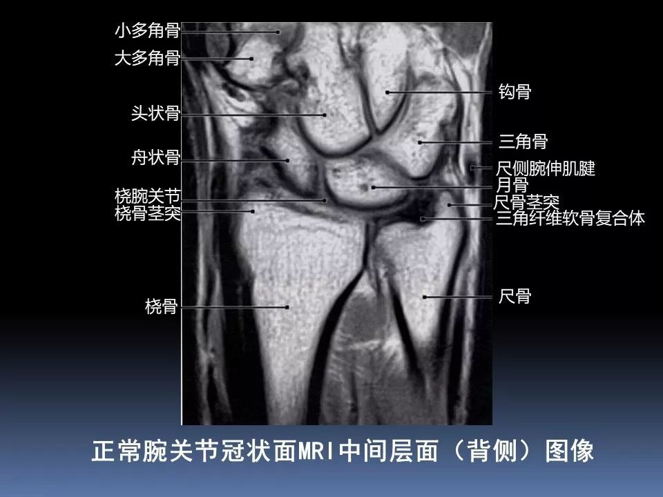 【骨科学术】腕关节的mri解读,最全了!