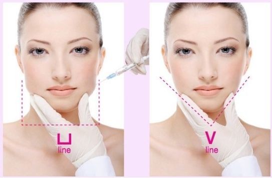 我主要是为了提升下颌缘,让面部轮廓更清晰,才顺带买的瘦脸针套餐