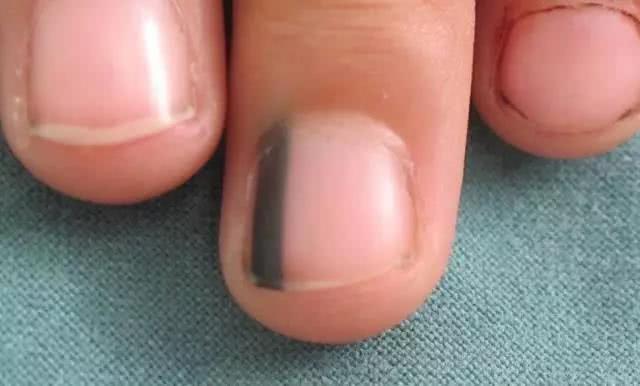 体内有癌,指甲先知?医生忠告:若指甲长这样,警惕是癌变的征兆