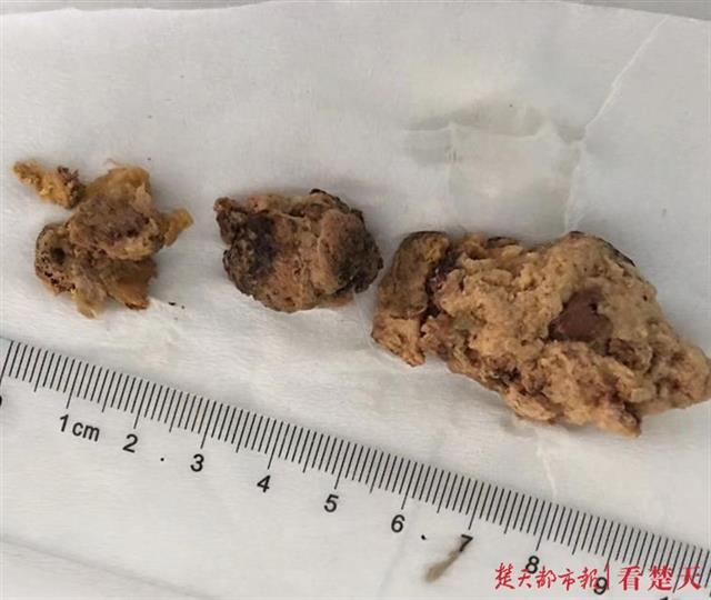 空腹吃柿子又惹祸 女子胃里长出7厘米大"结石"