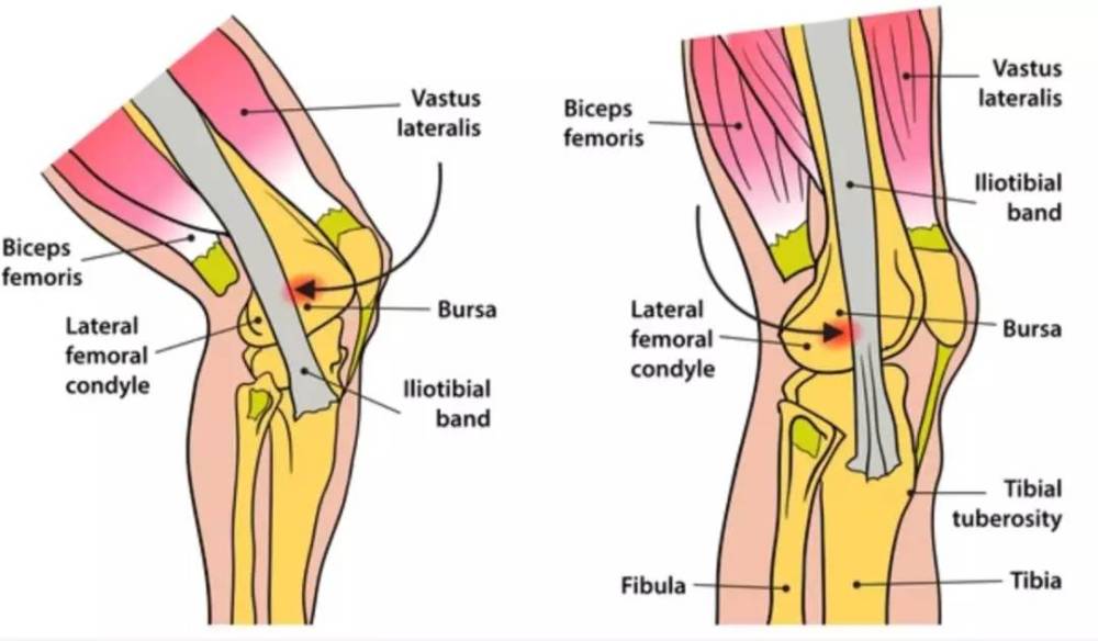 髂胫束摩擦综合症 跑步膝 的5个相关因素 越早知道越好 腾讯新闻