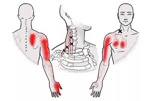 斜角肌位於胸鎖乳突肌內側,在上背部的疼痛處理中常常會被忽略.
