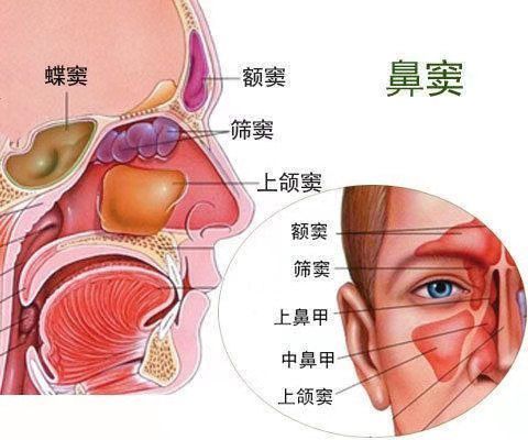 一個或多個鼻竇發生炎症稱為鼻竇炎,累及的鼻竇包括:上頜竇,篩竇,額竇