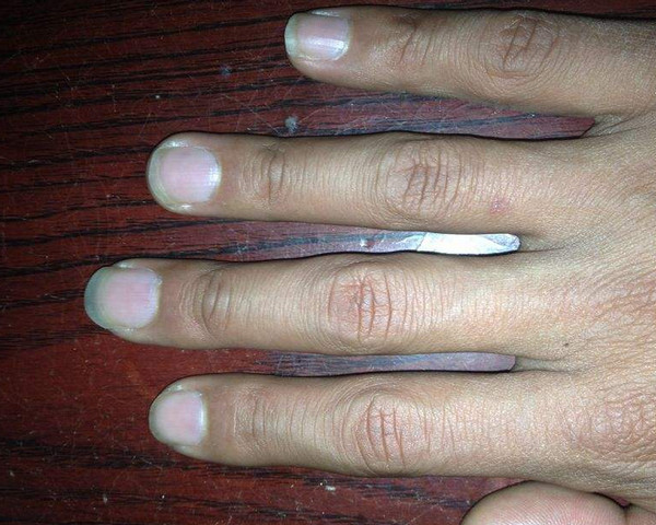 杵状指形成原因,杵状指鉴别方式!