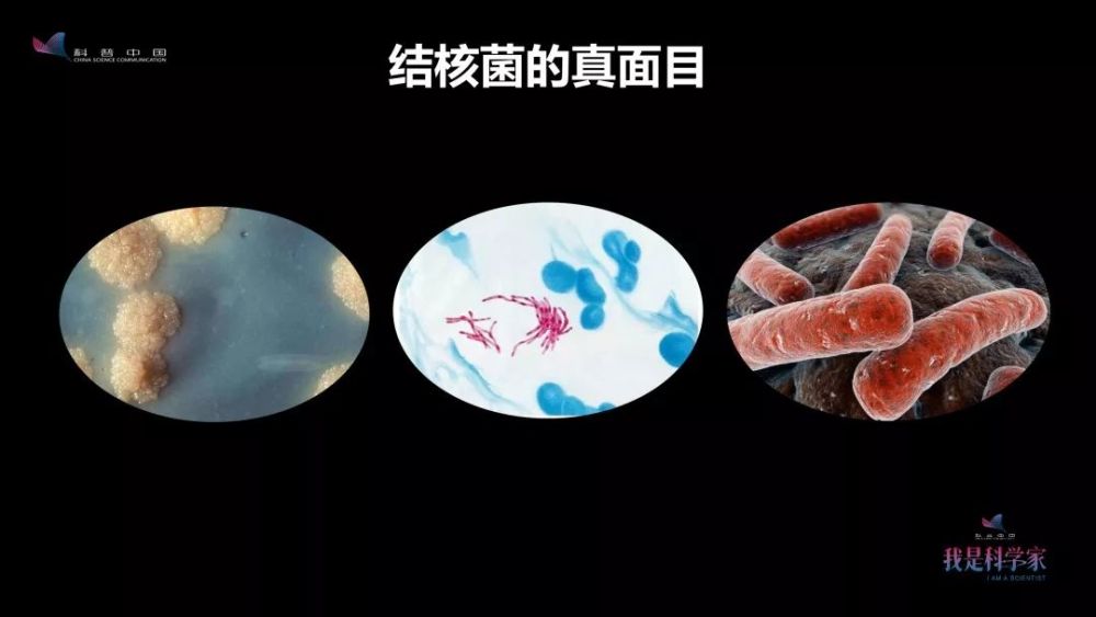 全球20亿人携带结核菌我的工作是拆掉这些定时炸弹