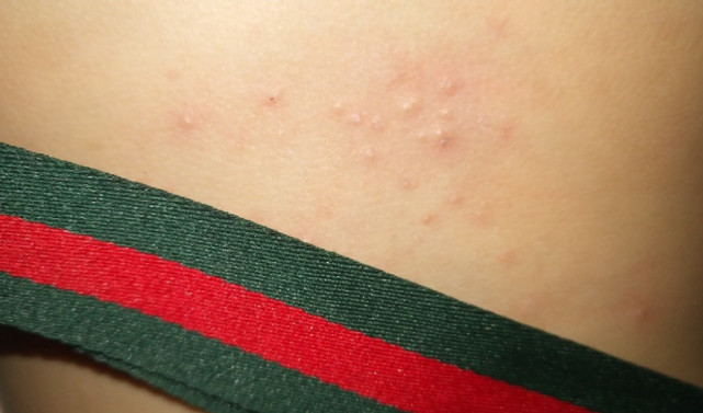 年龄大的朋友肯定知道缠腰蛇这种疾病到底是怎么回事