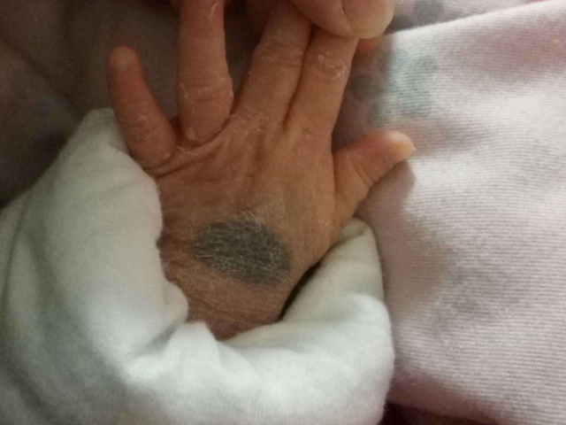 胎记真的是前世死亡的致命伤吗都来看看到底是什么原因吧别无知了