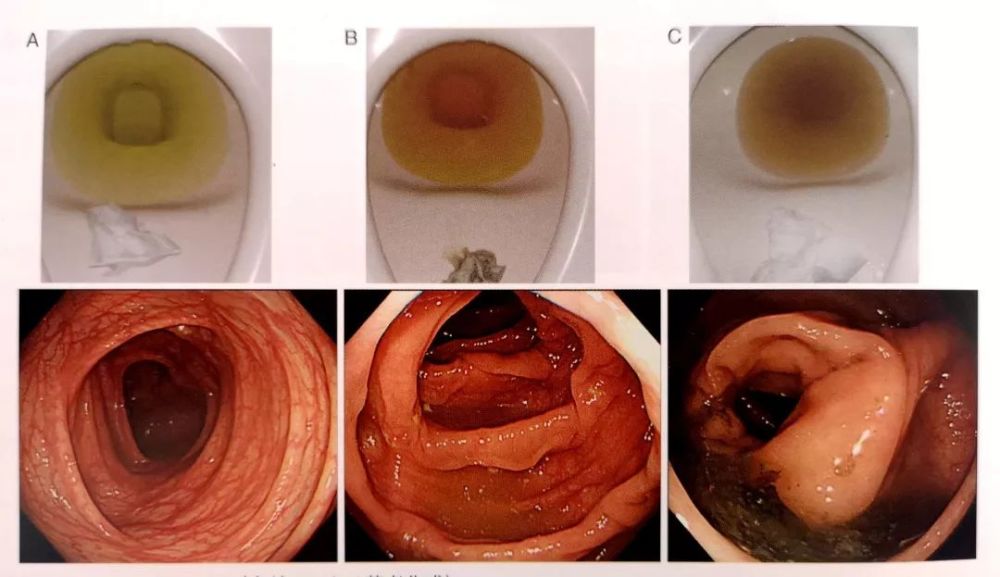 肠镜检查,你真的准备好了吗?——谈谈肠镜检查前的准备