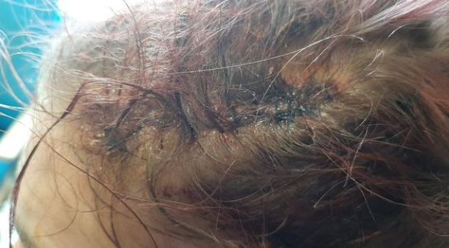 美女志愿者好心为流浪者施粥 却被流浪者养的秋田犬咬得头破血流 腾讯新闻