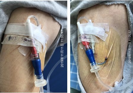 44床是一位肿瘤患者,其右上臂留置了一根picc导管,上一次更换敷贴的